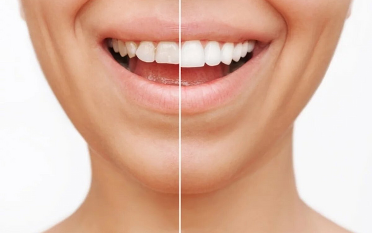 Dental Veneers For Front Teeth