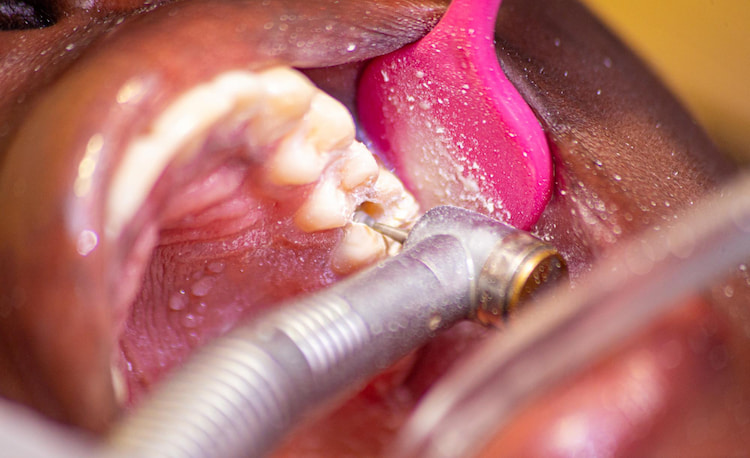a tooth is being drilled during root canal treatment in Scarborough.