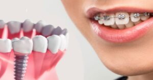 Getting Braces After Implants: Is It Safe or Effective?