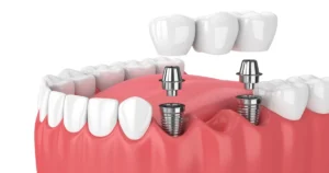 Are Dental Implants Covered by Insurance in Canada?