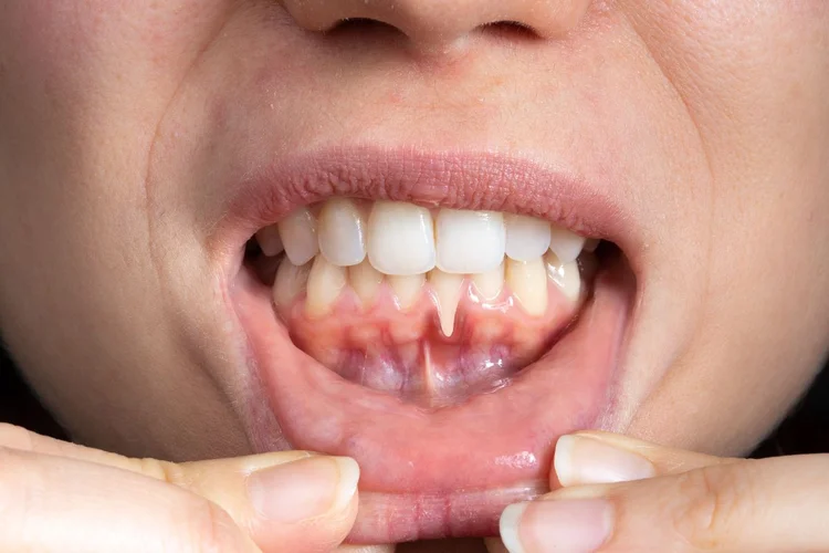 A picture of a person showing her gums by holding her lower lip