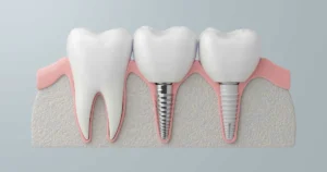 Types of Dental Implants Should You Know
