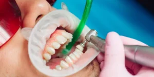 How Often Should You Get a Professional Teeth Cleaning in Toronto?