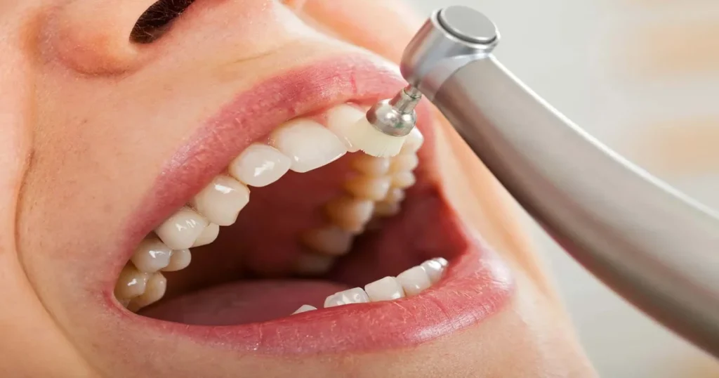 a picture of professional teeth cleaning