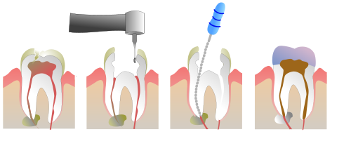 Root Canal Treatment